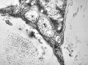 M, 10y. | Coffin-Lowry syndrome M, 10y. | Coffin-Lowry syndrome